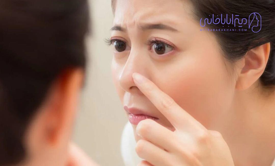 علت و درمان فوری جوش روی بینی چیست؟! | میترا باباخانی